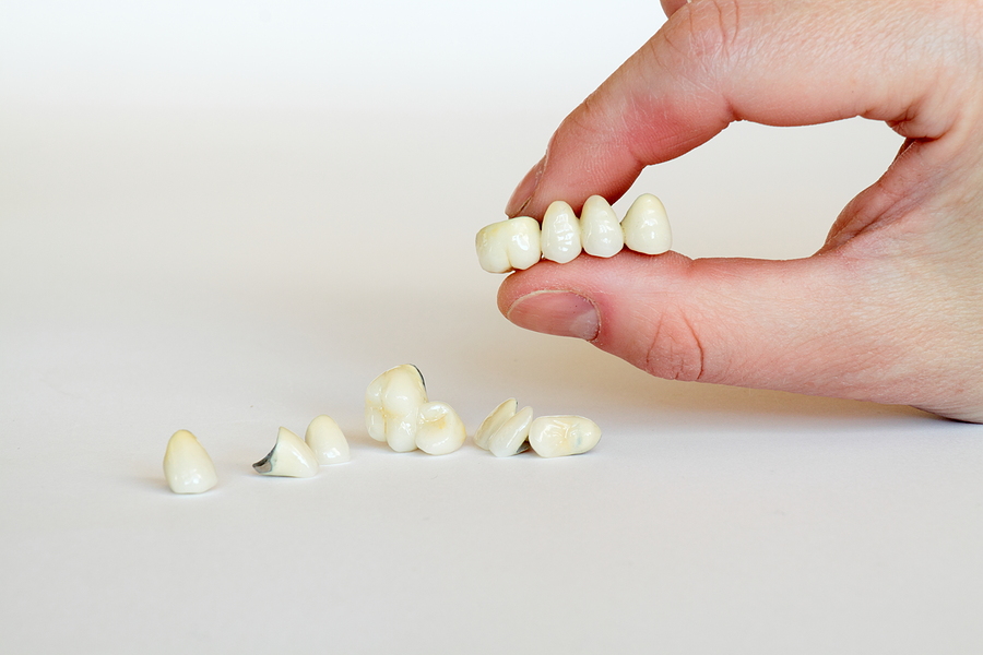 Restoring Your Smile with Crowns and Bridges in Los Angeles, CA: A Comprehensive Guide