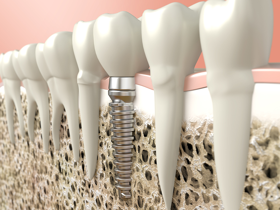 Achieve a Lasting Smile with Dental Implants in Los Angeles, CA