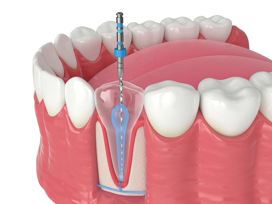 Understanding Endodontics: Saving Your Natural Teeth with Specialized Care