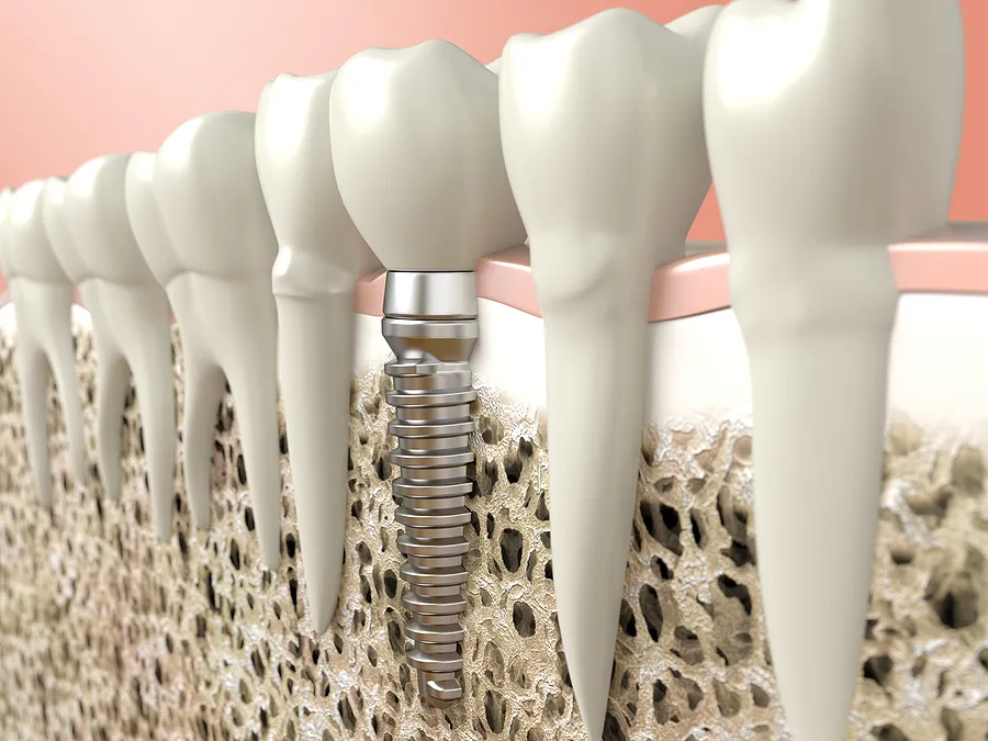 Achieve a Lasting Smile with Dental Implants in Los Angeles CA